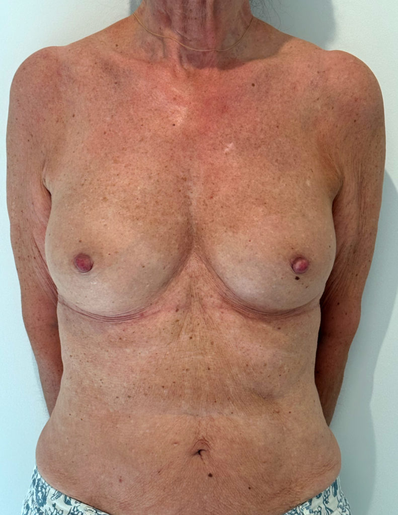 Breast experts Article AugmentationMammaire Lipofiling postop3