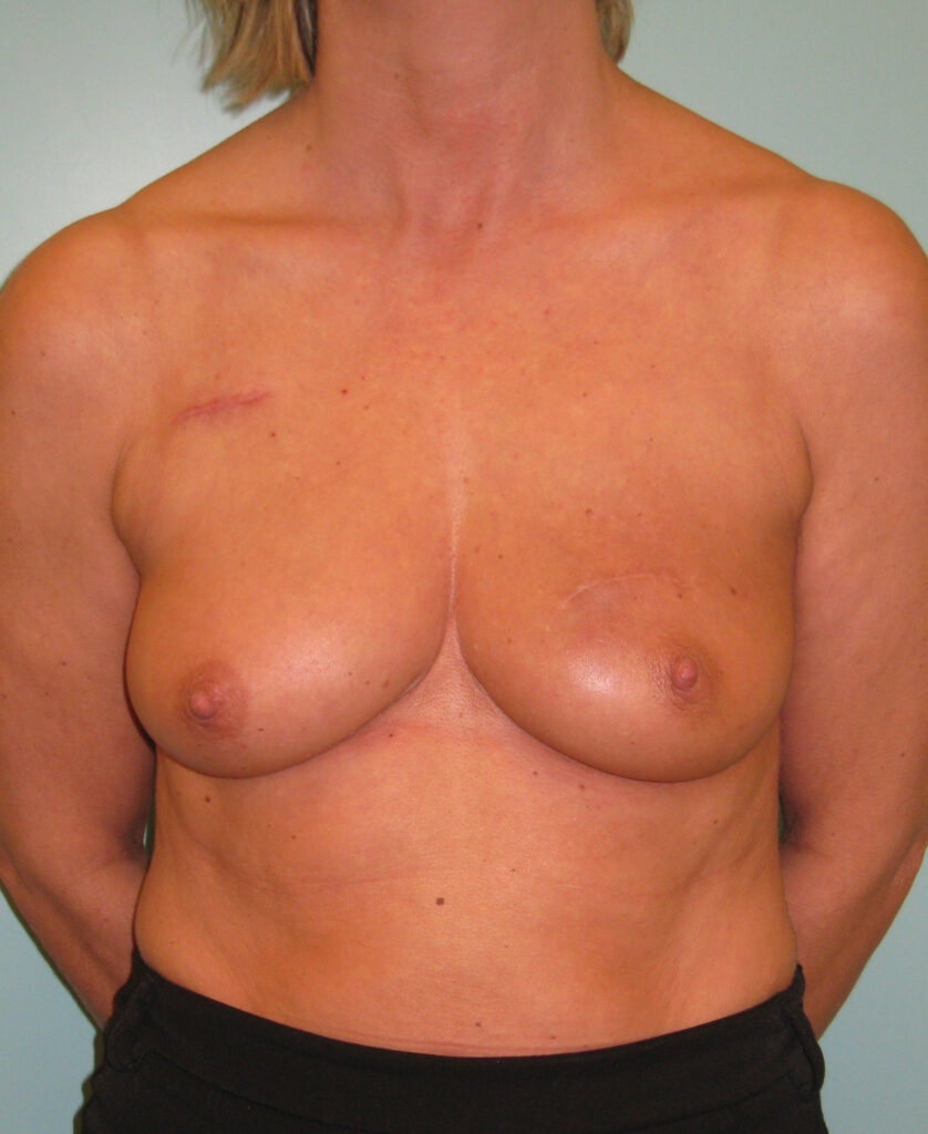 Breast experts apres chirurgie conservatrice 1