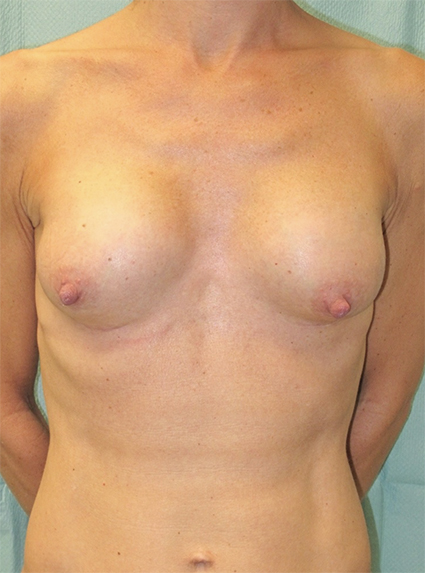 Breast experts contracture capsulaire avant