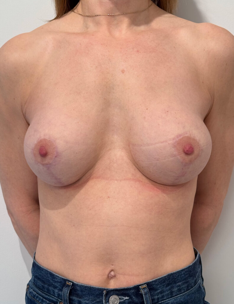 Breast experts correction de lifting apres 2