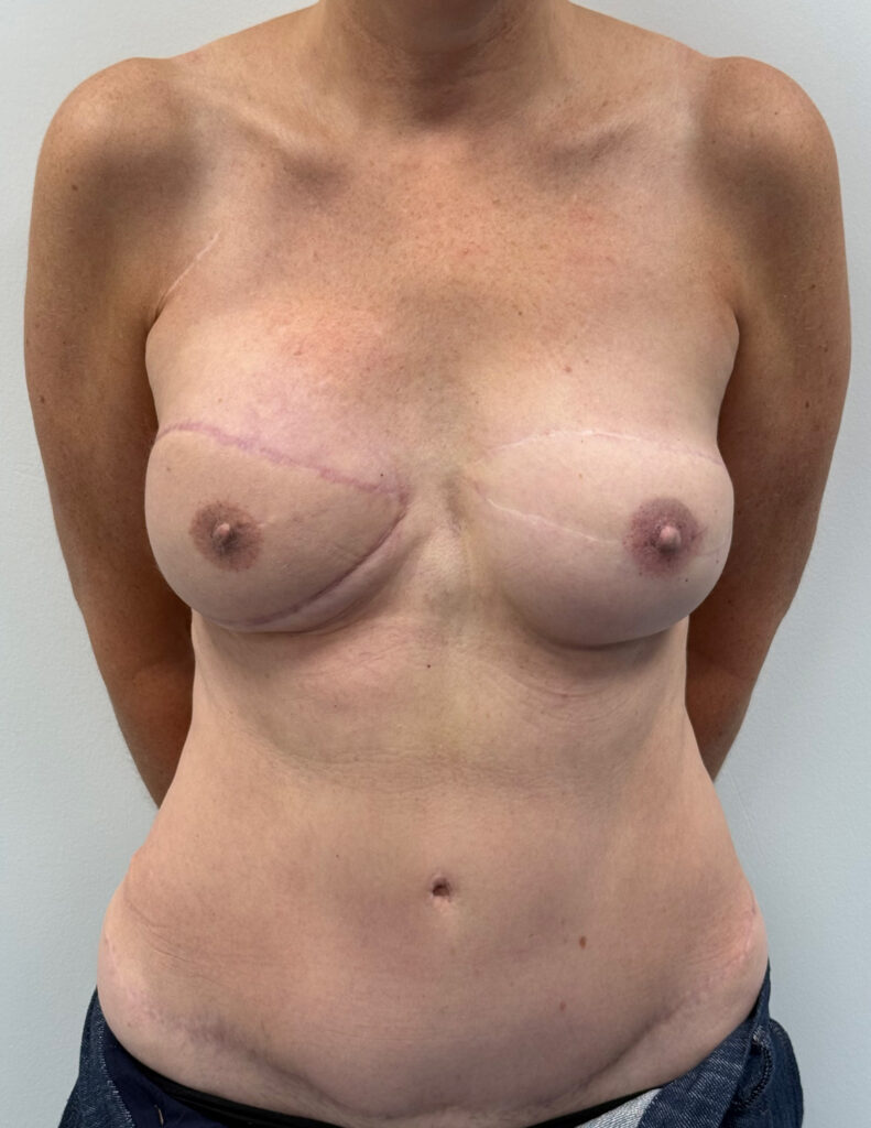 Breast experts echecs de reconstruction apres 2