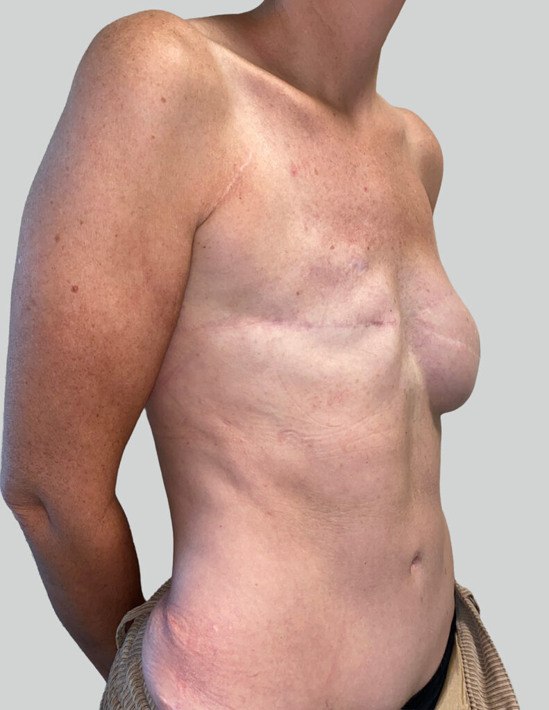 Breast experts echecs de reconstruction avant 3