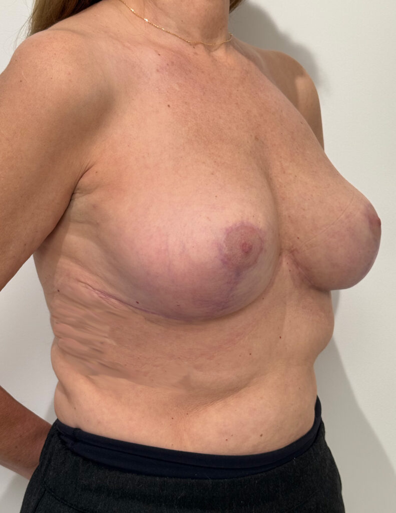 Breast experts lifting infection et necrose apres 3