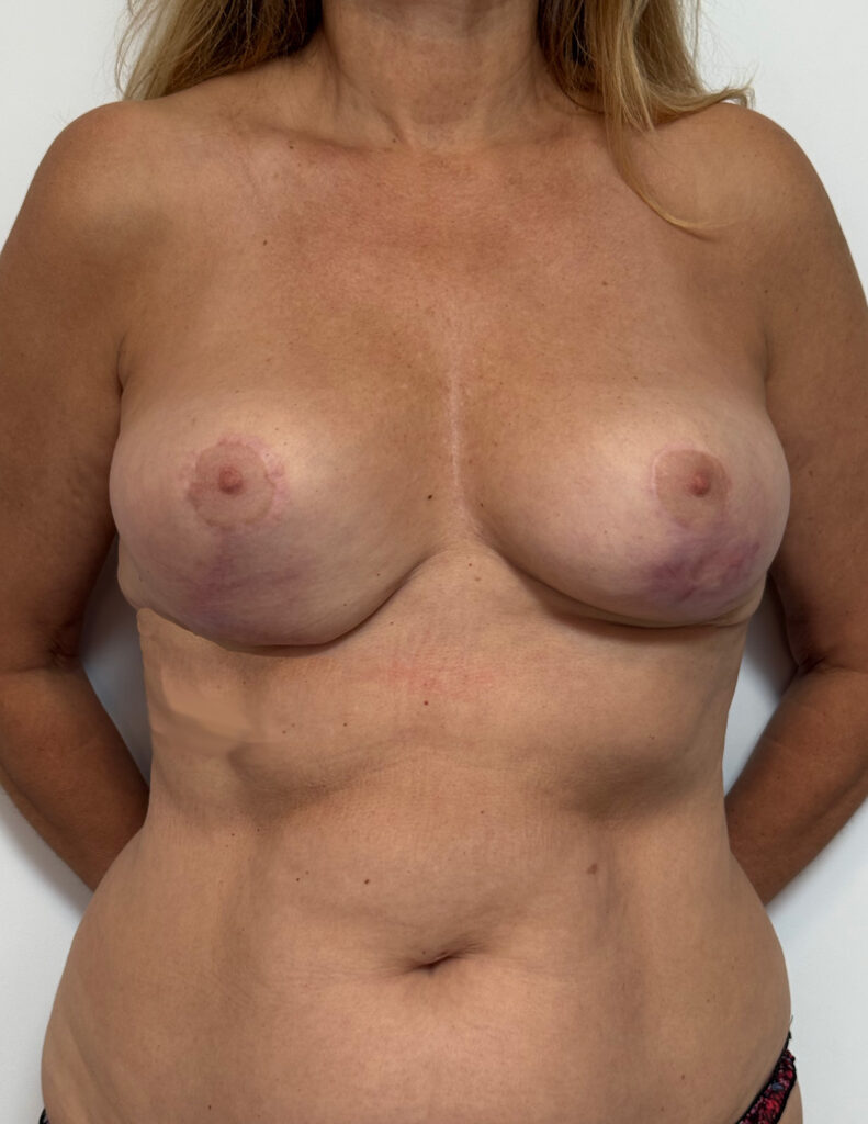 Breast experts lifting infection et necrose avant 2