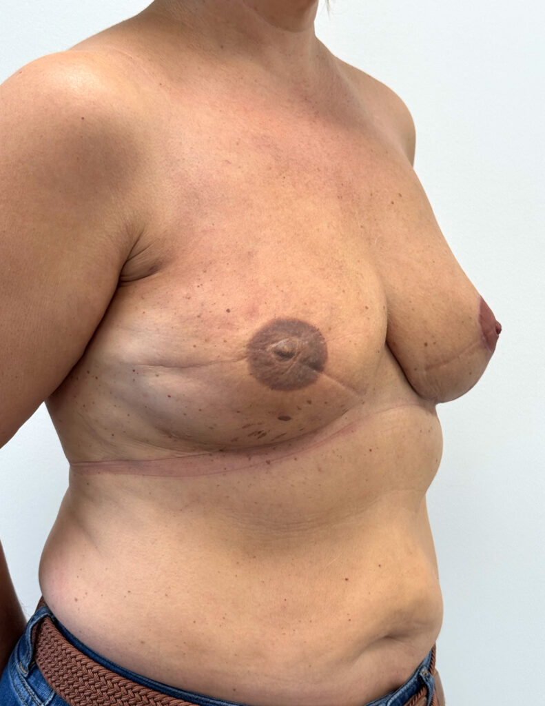 Breast experts reconstruction complete apres 3