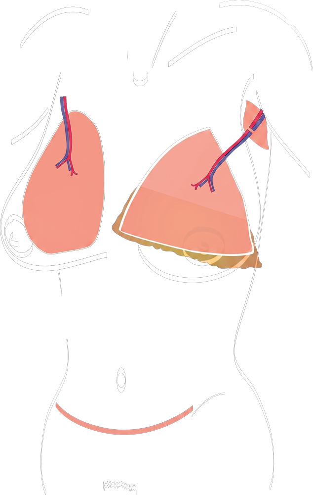 BreastExperts Augmentation mammaire par lambeau DIEP illustration 04