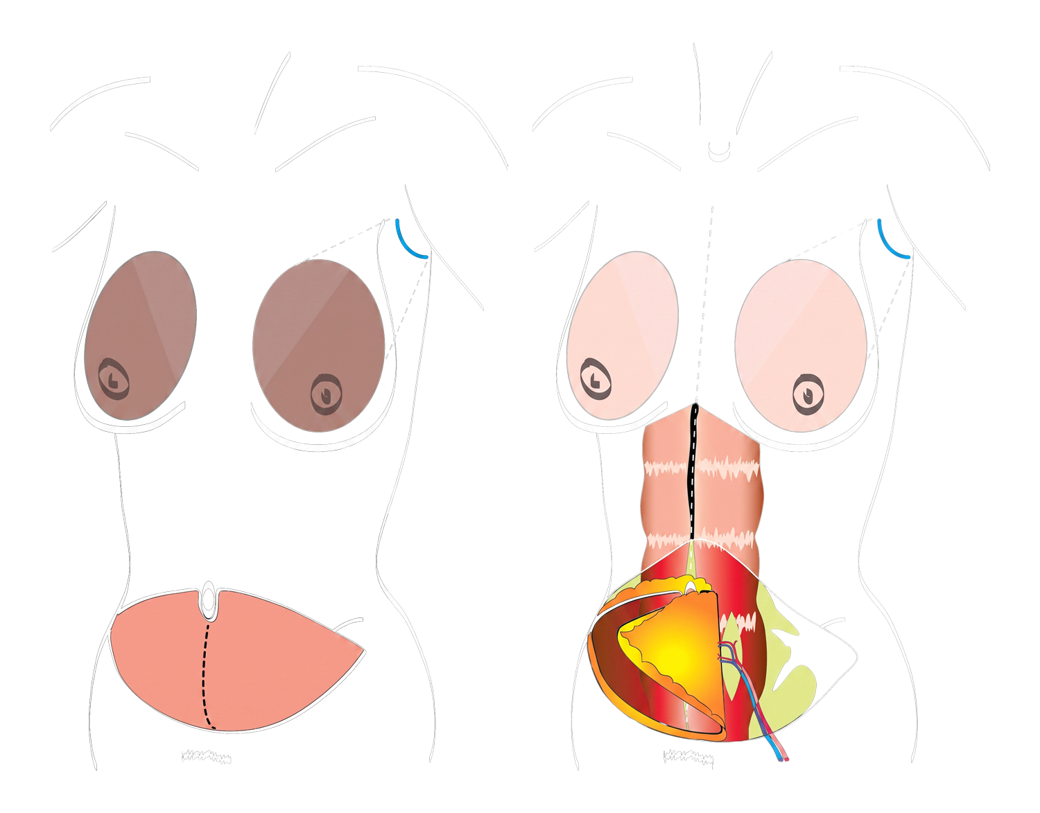 BreastExperts Augmentation mammaire par lambeau DIEP illustration 05