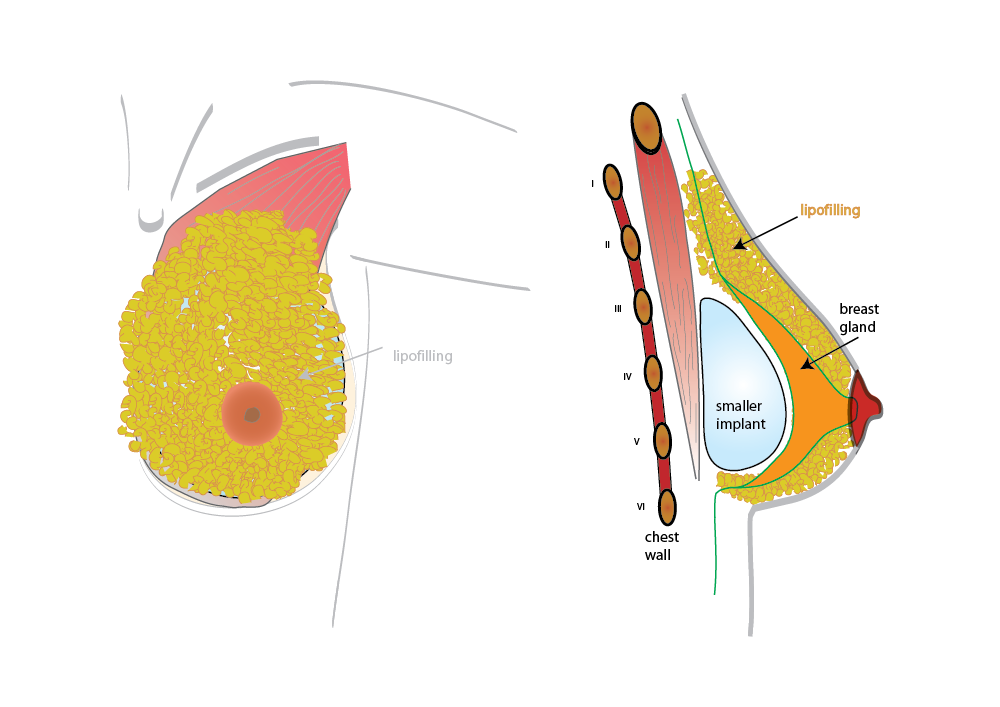augmentation