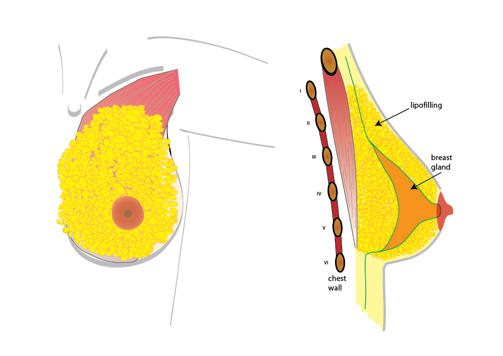 lipofilling