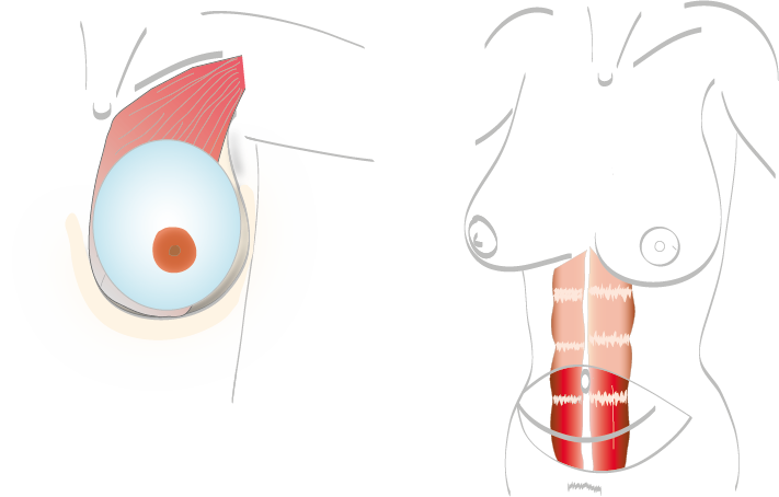 BreastExperts AugmentationMammaire LambeauDiep2
