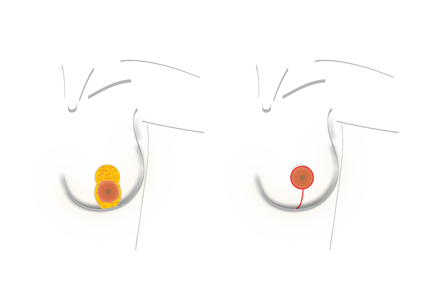 BreastExperts Liftingmammaire sansaugmentation