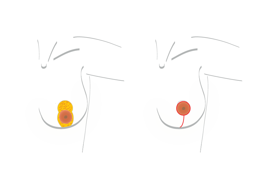 BreastExperts Liftingmammaire sansaugmentation2